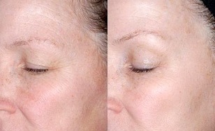 तस्वीरों से पहले और बाद में आंखों के आसपास की त्वचा का कायाकल्प