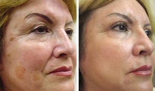 तस्वीरों के पहले और बाद में आंशिक त्वचा कायाकल्प