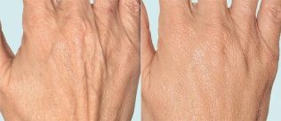 भिन्नात्मक चिकित्सा से पहले और बाद में हाथ की त्वचा